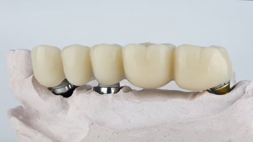 dental bridges