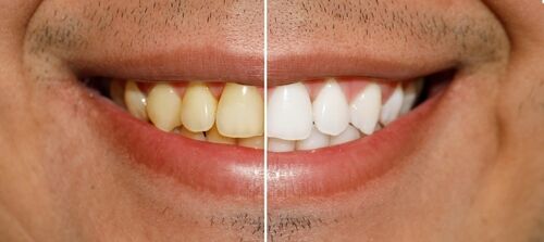 teeth whitening in Virginia