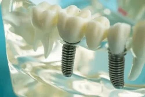 A translucent display of dental implants as an option for tooth replacement.